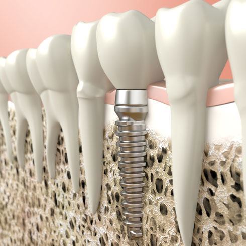 Dental Implants